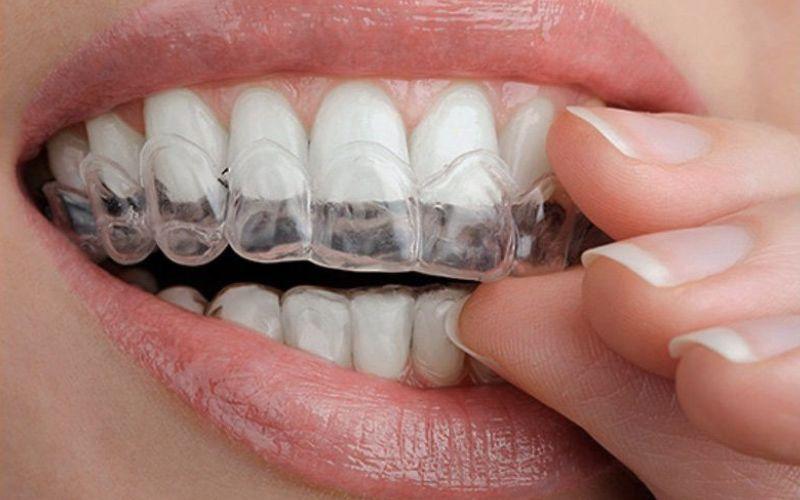 Máng tẩy trắng răng có thực sự mang lại hiệu quả? Cùng khám phá những lợi ích, hạn chế và cách sử dụng đúng cách của sản phẩm này.