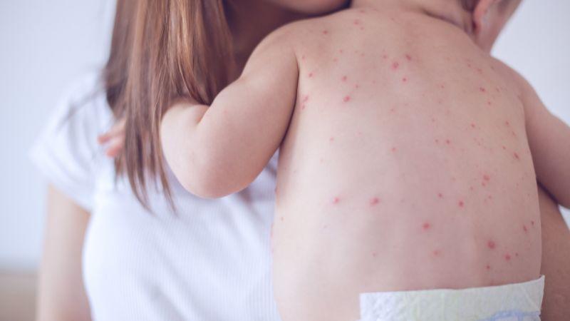 Khi bị thủy đậu, liệu có cảm giác ngứa ngáy không? Dưới đây là 7 cách hiệu quả để giảm bớt cảm giác khó chịu này.
