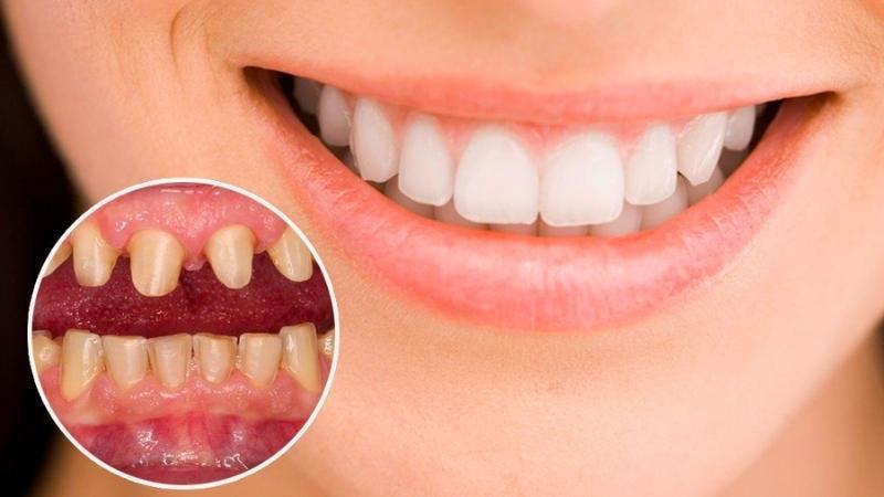 Răng thưa phải làm sao? Dưới đây là 5 phương pháp điều trị răng thưa hiệu quả ngay tại nhà.