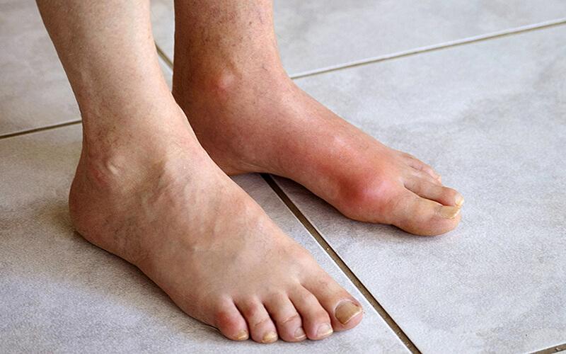 Người bị bệnh gút nên ăn gì? Khám phá 10 thực phẩm giúp người bệnh gout cải thiện sức khỏe.