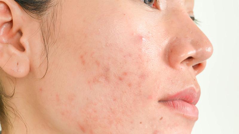 7 dấu hiệu cho thấy mỹ phẩm bạn đang dùng không còn phù hợp với da, hãy thay đổi ngay để tránh lãng phí tiền bạc!