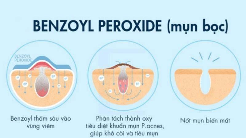 Benzoyl Peroxide là gì? Tác dụng và cách sử dụng hiệu quả