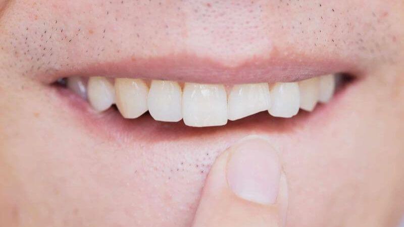 Khám phá 6 nguyên nhân khiến răng sứ dễ bị mẻ và những cách xử lý khi gặp phải