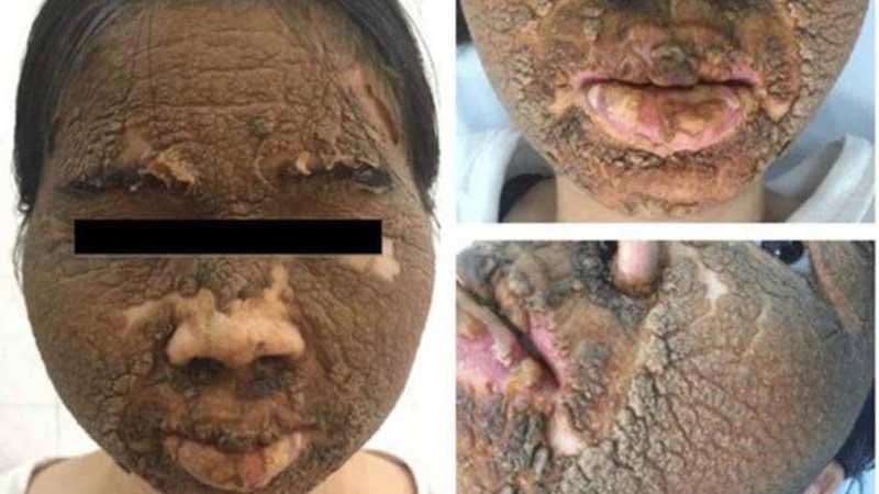 Hãy tránh xa việc dùng rượu thuốc để trị mụn, đây mới là phương pháp an toàn và hiệu quả nhất