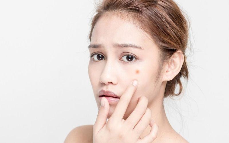 Mụn hình thành do đâu? Khám phá 9 phương pháp trị mụn hiệu quả từ thiên nhiên