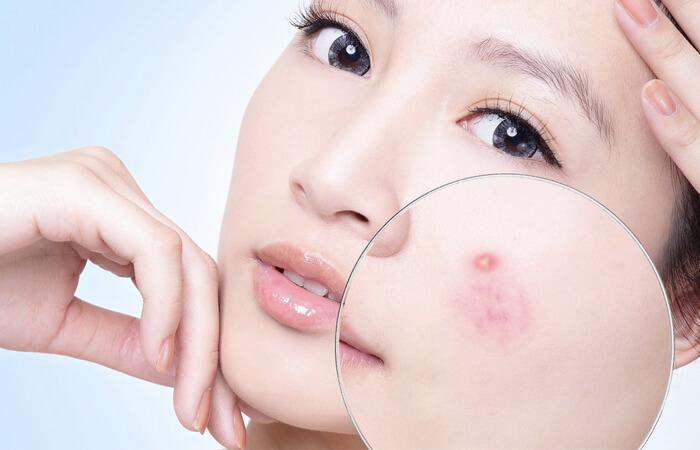 Acid Salicylic là gì? Công dụng và những lưu ý quan trọng khi sử dụng