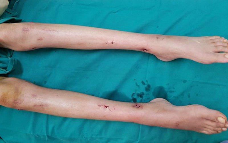 Phẫu Thuật Kéo Dài Chân: Những Điều Bạn Chưa Biết