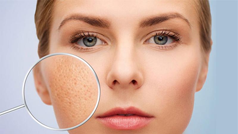Hãy khám phá những cách trị sẹo rỗ ngay tại nhà với các nguyên liệu tự nhiên dễ tìm và mang lại hiệu quả rõ rệt trong thời gian ngắn.