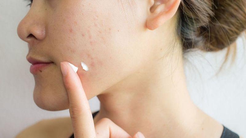 Kem trị mụn là sản phẩm không thể thiếu trong việc chăm sóc da mụn. Vậy thực chất kem trị mụn là gì và những loại kem nào đang dẫn đầu trong việc trị mụn hiện nay?