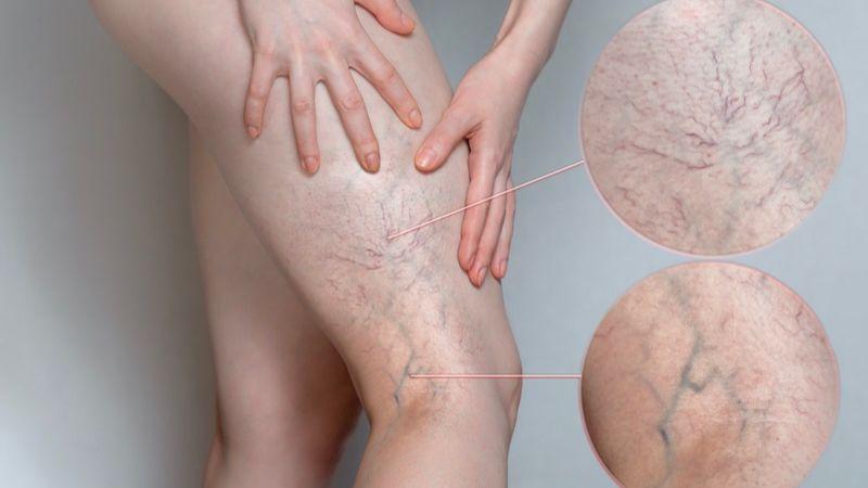 Có nên ngâm chân đối với người mắc suy giãn tĩnh mạch?