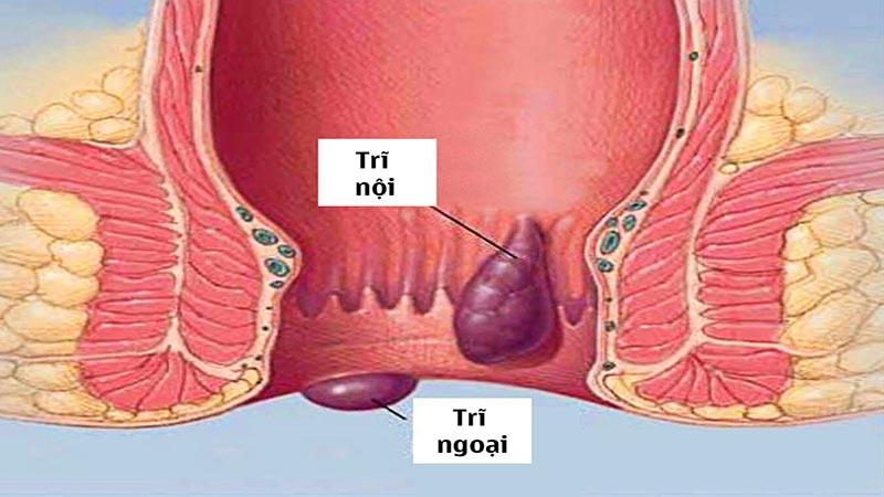 Khi mắc bệnh trĩ, bạn nên làm gì? Phương pháp điều trị hiệu quả và nhanh chóng nhất