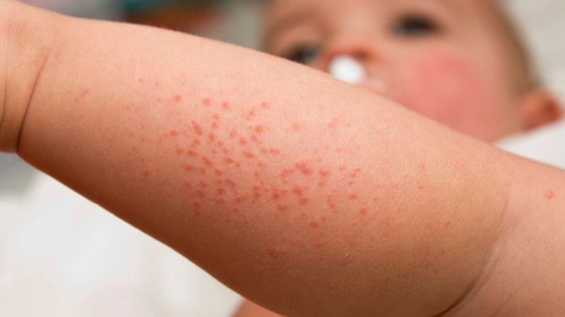 Có cần thiết cho trẻ em giải độc gan định kỳ không?