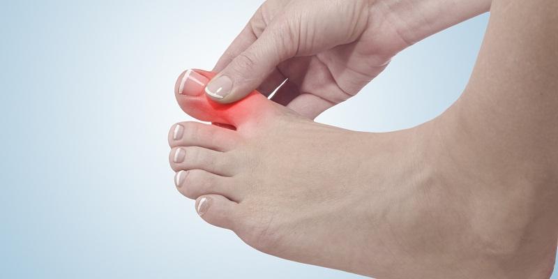 Các phương pháp hiệu quả giảm cơn đau cho người bị Gout