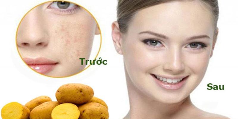 Bí quyết trị nám hiệu quả từ khoai tây đông đá