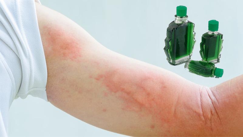 Có nên thoa dầu khi cơ thể bị nổi mề đay?
