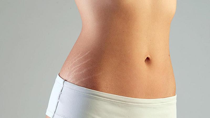 Vết rạn da ở tuổi dậy thì - nguyên nhân và phương pháp điều trị
