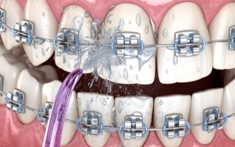 Hướng dẫn sử dụng máy tăm nước cho người niềng răng