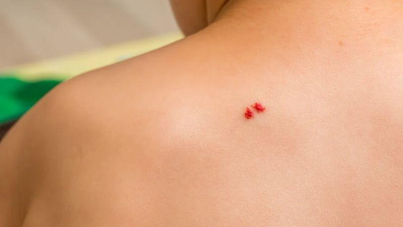 Nốt ruồi son là gì? Việc da xuất hiện nhiều nốt ruồi son có ảnh hưởng gì không?