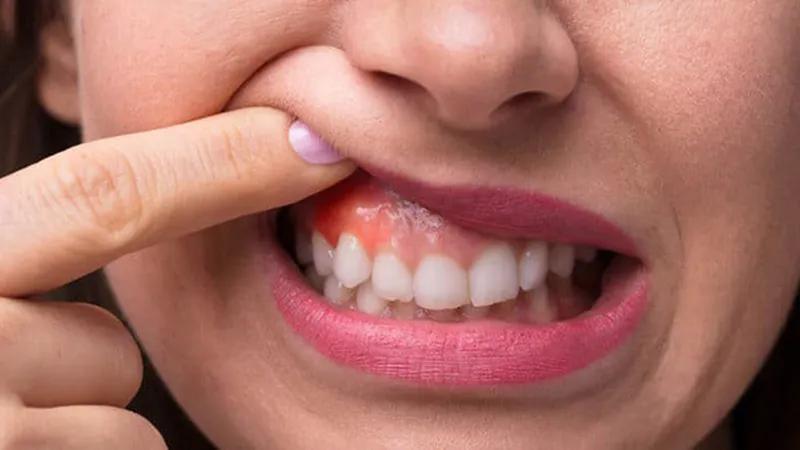 Người bị viêm chân răng cần biết nên ăn gì và kiêng gì để giúp quá trình hồi phục nhanh chóng và hiệu quả hơn?