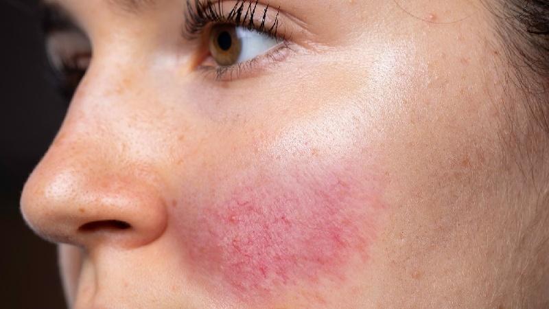 Cách phục hồi làn da sau khi sử dụng kem trộn hiệu quả