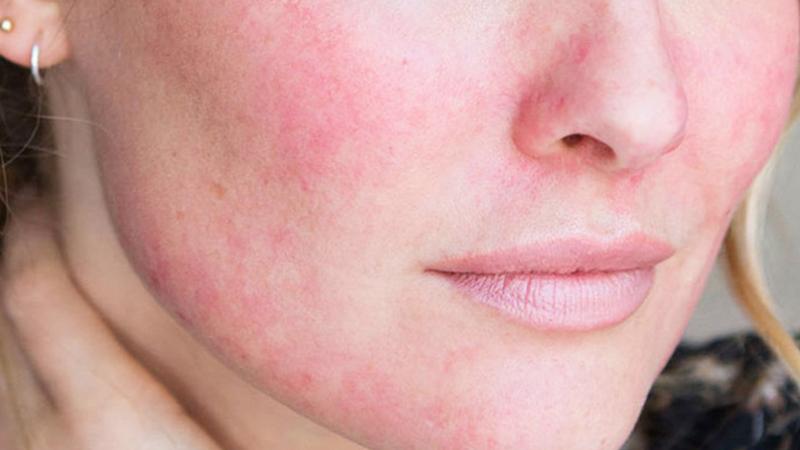 Serum Niacinamide có thể gây kích ứng và đỏ da? Những điều cần biết khi sử dụng Niacinamide.