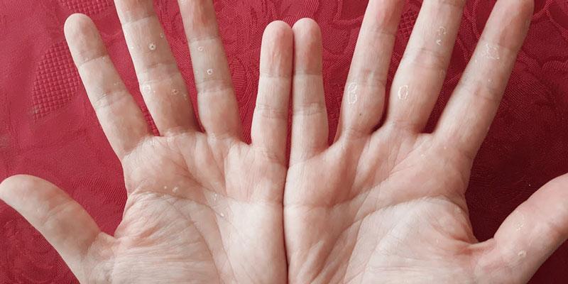 Những dấu hiệu cảnh báo bạn đang thiếu Vitamin C nghiêm trọng