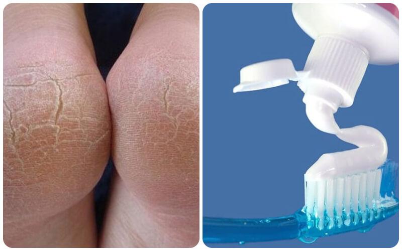Hướng dẫn sử dụng kem đánh răng để trị nứt gót chân một cách hiệu quả và an toàn.