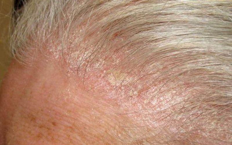 Tại sao da đầu lại khô và tróc vảy vào mùa đông? Các phương pháp điều trị hiệu quả