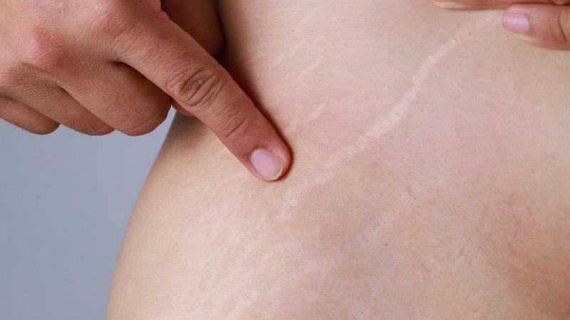 Khám phá các sản phẩm kem trị rạn da được đánh giá cao và mang lại hiệu quả rõ rệt