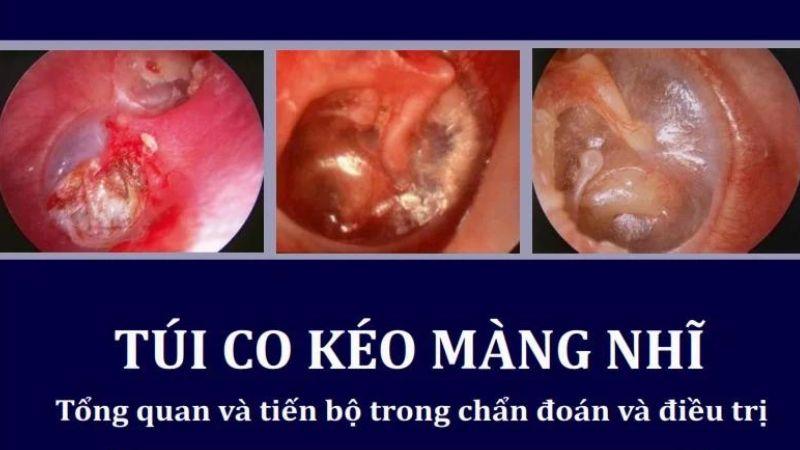 Viêm tai xẹp nhĩ ở trẻ em là một bệnh lý khó nhận diện nhưng có thể gây ảnh hưởng nghiêm trọng nếu không được phát hiện và điều trị kịp thời. Liệu bệnh này có thực sự nguy hiểm đối với trẻ?