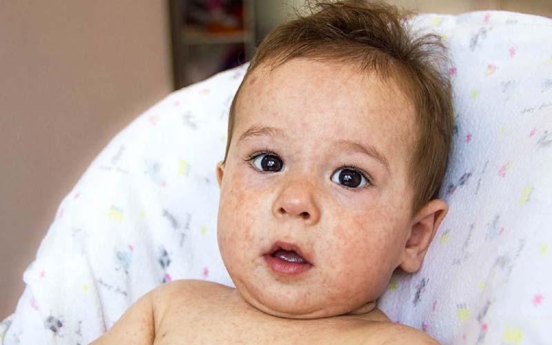 5 cách chữa lang ben tại nhà cho trẻ sơ sinh, an toàn và hiệu quả