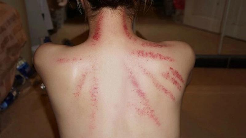 Cạo gió bằng bạc có thực sự mang lại hiệu quả tốt cho sức khỏe? Khám phá cách thức và tác dụng của phương pháp này để hiểu rõ hơn về lợi ích của nó.