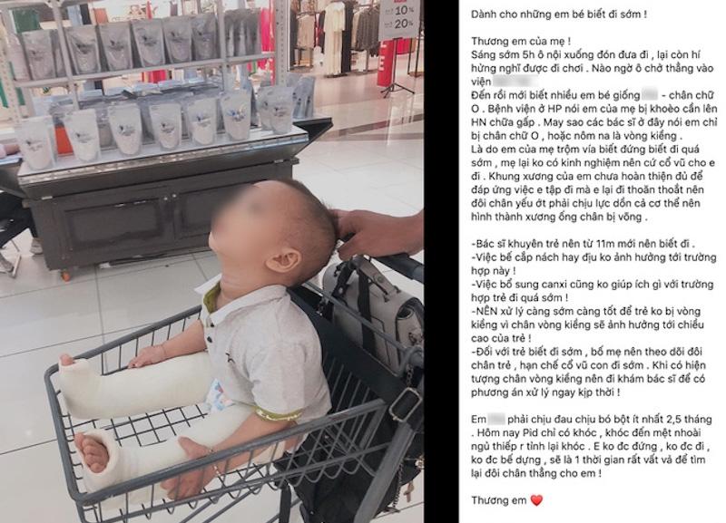 Bác sĩ Nhi khoa chia sẻ về việc trẻ đi sớm có thể bị chân vòng kiềng