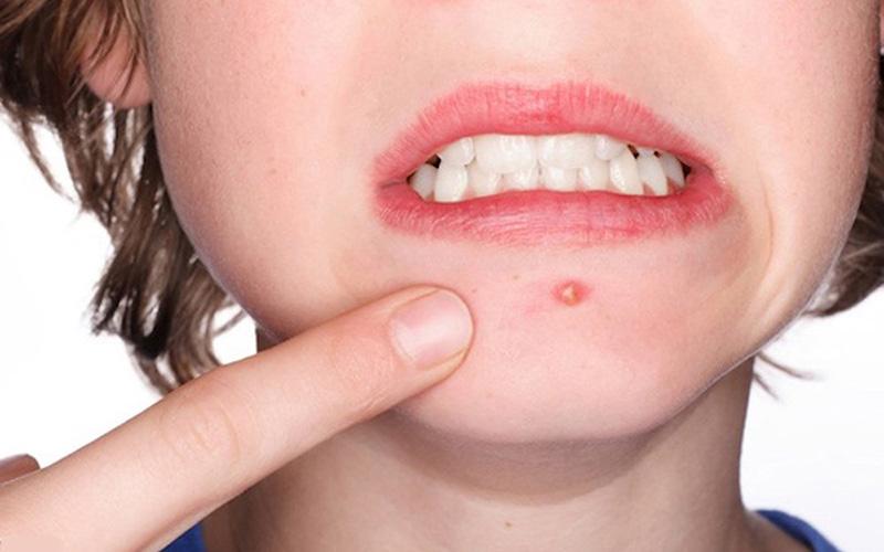5 phương pháp trị mụn bọc tại nhà đơn giản mà hiệu quả