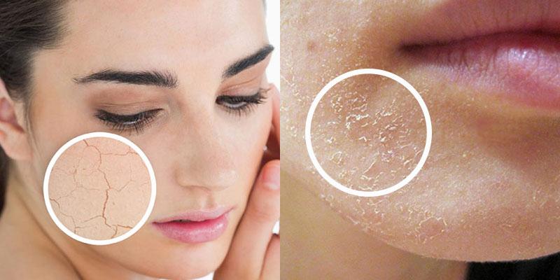 Tại sao da mặt lại dễ bị khô và bong tróc mỗi khi giao mùa?