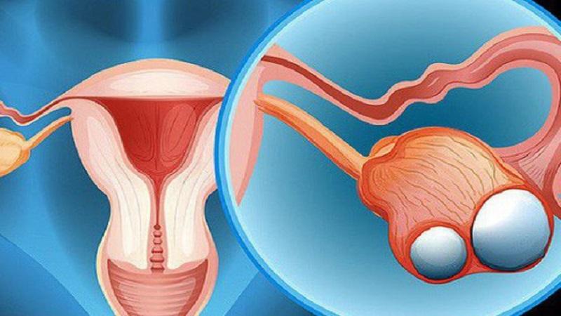 U nang buồng trứng có thực sự nguy hiểm không? Những phương pháp điều trị nào là hiệu quả?