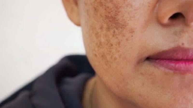 Các bước chăm sóc da mặt giúp làm mờ nám và tàn nhang hiệu quả, mang lại làn da sáng mịn chỉ trong thời gian ngắn