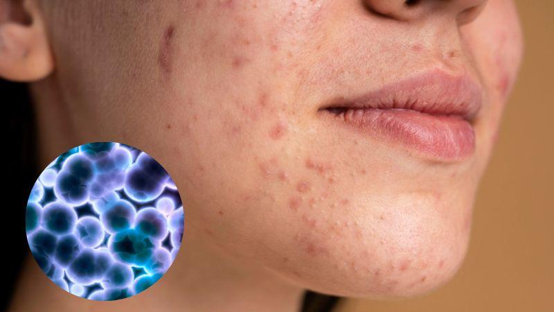 Vi khuẩn P. Acnes là gì? Nguyên nhân và cách xử lý hiệu quả