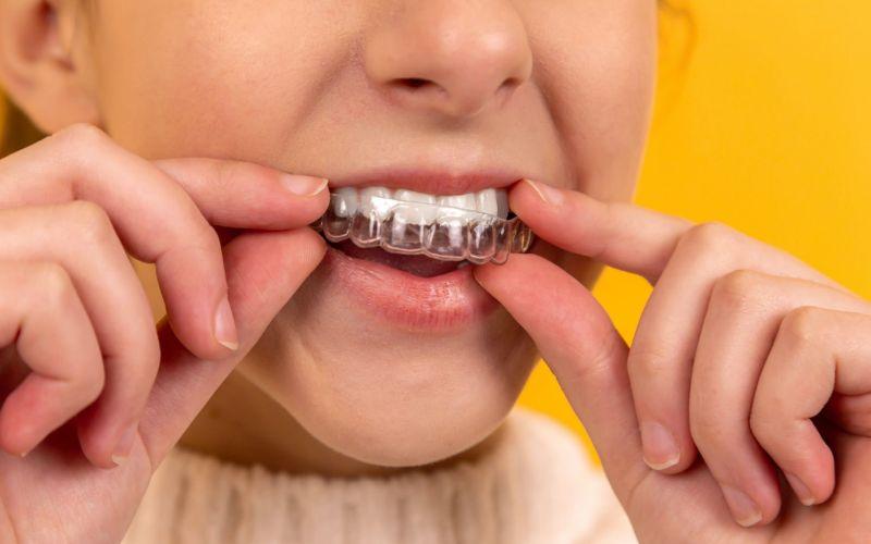 Hàm duy trì là gì? Cùng khám phá những lợi ích mà khí cụ này mang lại trong việc duy trì kết quả niềng răng lâu dài.