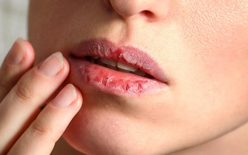 Lạm dụng son dưỡng môi quá nhiều sẽ dẫn đến những hậu quả không mong muốn.