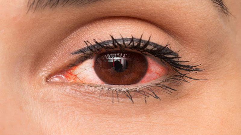 Những vấn đề thường gặp khi mới bắt đầu sử dụng kính áp tròng