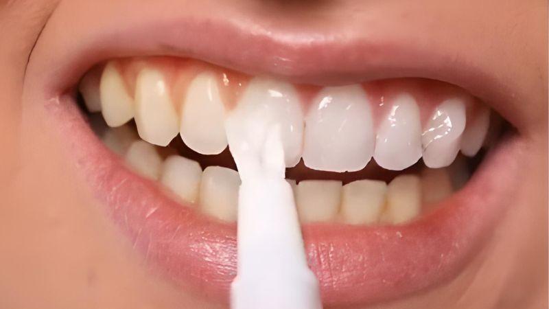 Bút tẩy trắng răng là gì và làm thế nào để sử dụng nó đúng cách để đạt hiệu quả tốt nhất? Hãy cùng khám phá những thông tin cần thiết về sản phẩm này!