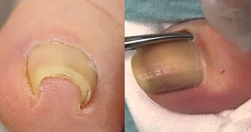 Lấy khóe móng chân: Nên hay không? Cách thực hiện an toàn