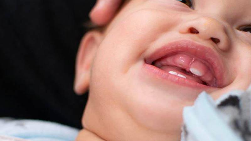 Mọc răng hàm dưới trước ở trẻ có thể gây ra vấn đề gì cho sức khỏe không?
