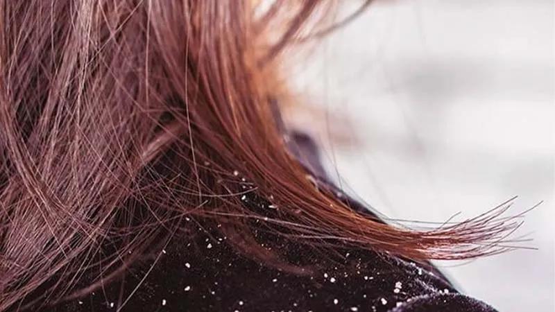 Bạn đã hiểu rõ nguyên nhân gây ra gàu chưa?