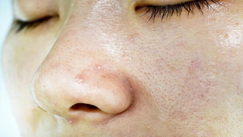 Mùa hè đến, da nhờn và mụn khiến bạn bối rối không biết nên chọn mặt nạ nào để kiềm dầu, làm sạch lỗ chân lông hiệu quả?