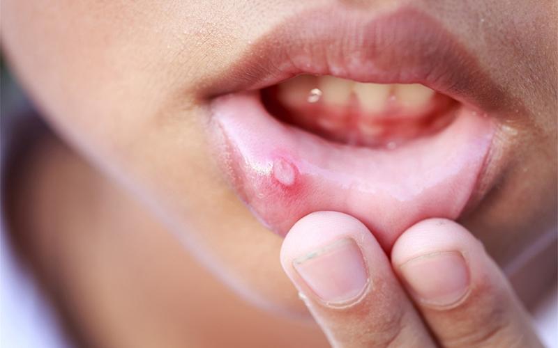 Nhiệt miệng nên ăn gì và kiêng gì để phục hồi nhanh chóng? Hãy cùng tìm hiểu các thực phẩm tốt và những món cần tránh trong bài viết dưới đây để giúp bạn khỏi cơn khó chịu này.