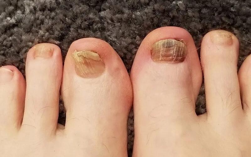 Móng chân bị đen là dấu hiệu gì và cách chữa trị hiệu quả