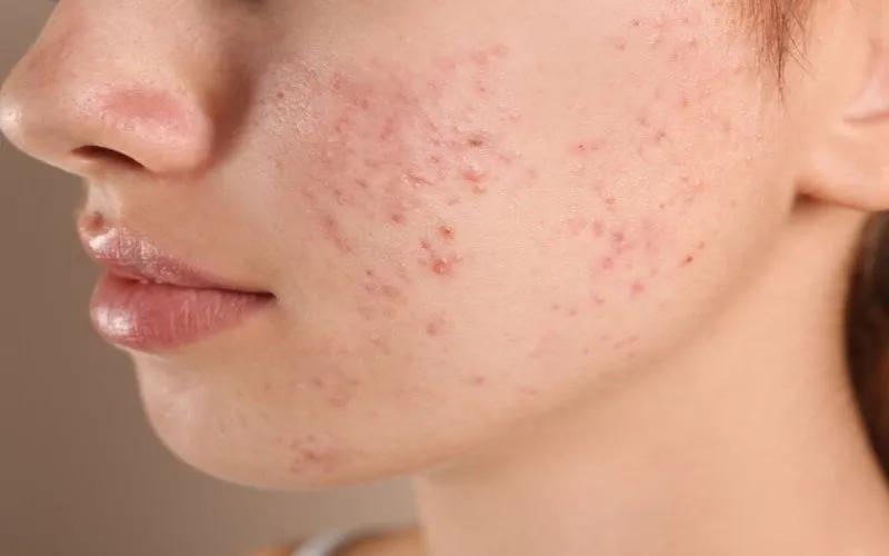Những rủi ro khi sử dụng baking soda không đúng cách