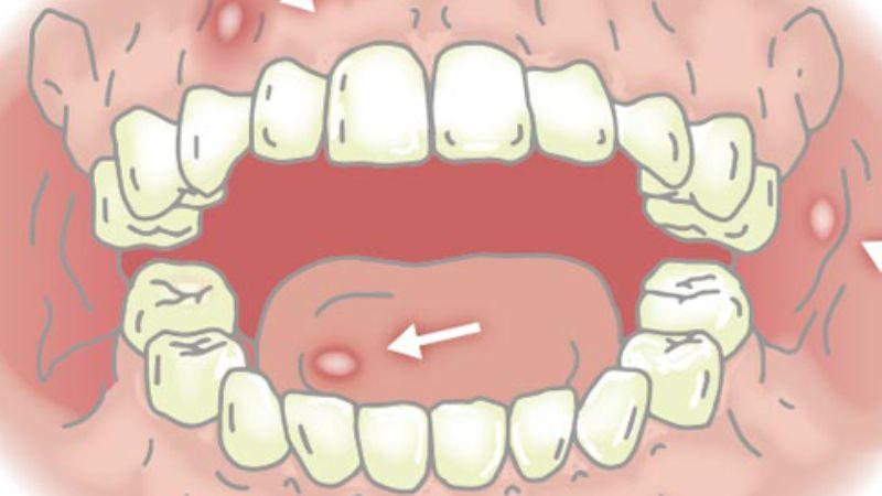 Khám phá 3 phương pháp đơn giản và hiệu quả để chữa nhiệt miệng bằng mật ong